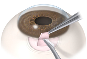 cirugia combinada glaucoma cirugia jjaristizabal