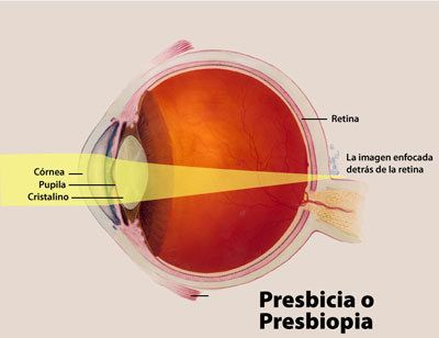cirugia presbicia jjaristizabal